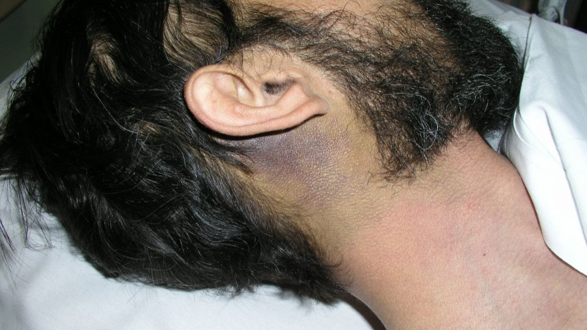 The Battle Sign: That Appears Behind The Ears. The Battle Sign: That Appears Behind The Ears.