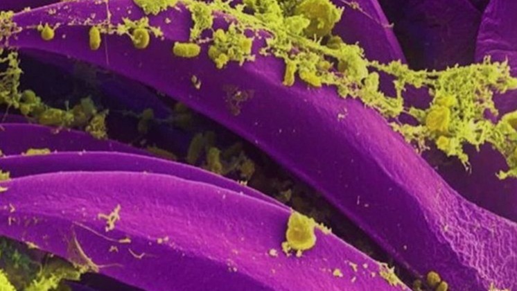 California Resident, Plague, First Time In Five Years, South Lake Tahoe,  first human case,  plague in California, fever,  sickness, global news