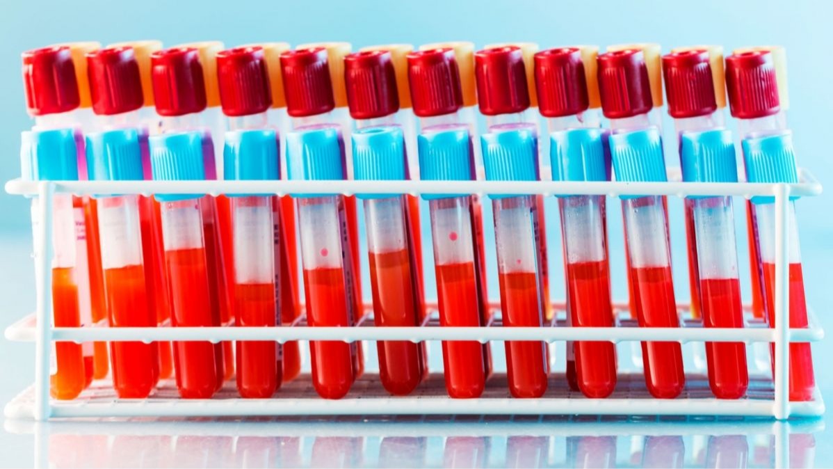 US, Treatment For Coronavirus Patients, Blood Plasma,  President Trump , AstraZeneca, Oxford University , Covid-19. , world news, global news