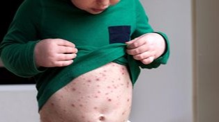 Chickenpox, health, people, Varicella-zoster virus (VZV), disease