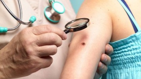 malignant melanoma, skin changes, Doctor, skin cancer, body