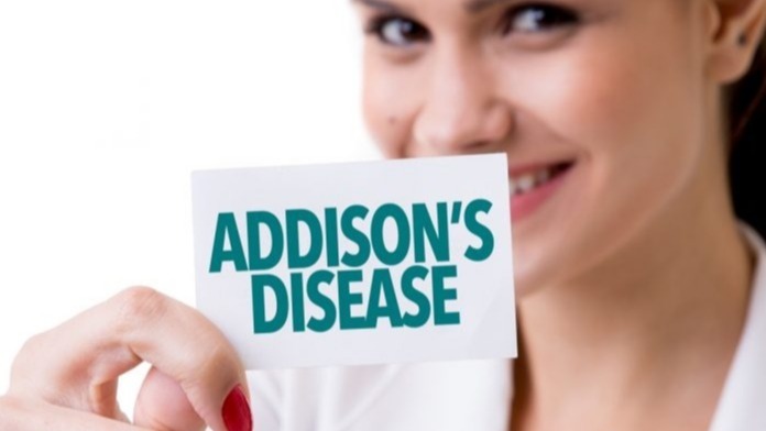 glandular disease, treatment,  Addison&rsquo;s unwellness, primary adrenal insufficiency , hypoadrenalism