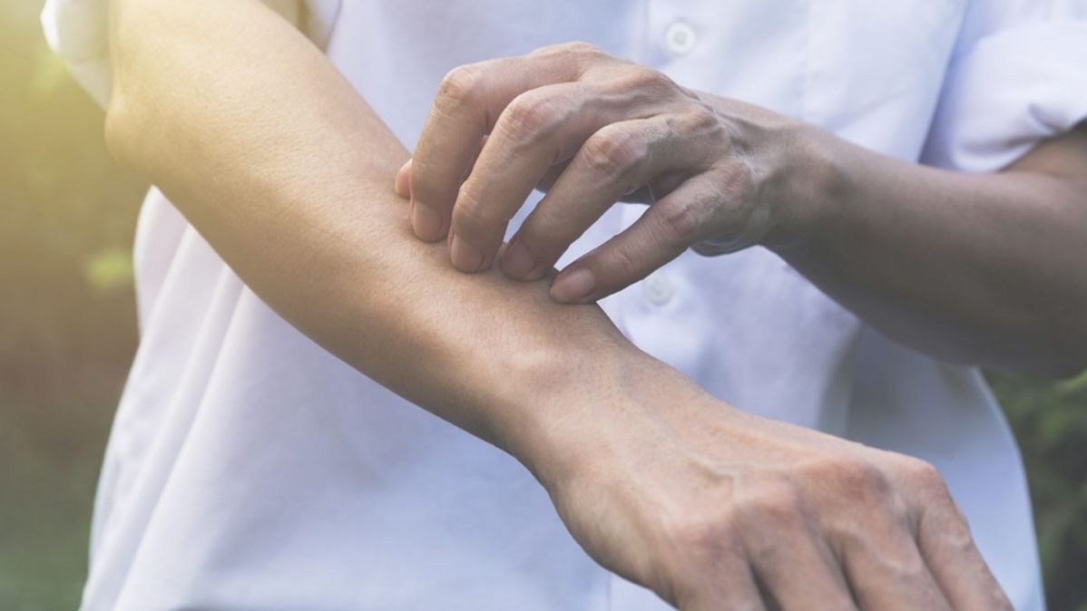 Histamine , nettle rash, haptic sensation , Tissues, urticaria, allergies