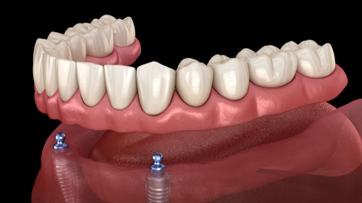 Dental Implants in Pune,  Best Dental Implants Pune,  Dental Implant Clinic Pune,  Tooth Implant Pune,  Implant Dentist Pune,  Dental Implant Treatment Pune,  Missing Teeth Replacement Pune,  Full Mouth Dental Implants Pune,  Single Tooth Implant Pune,  Dr Hileri Mori Pune