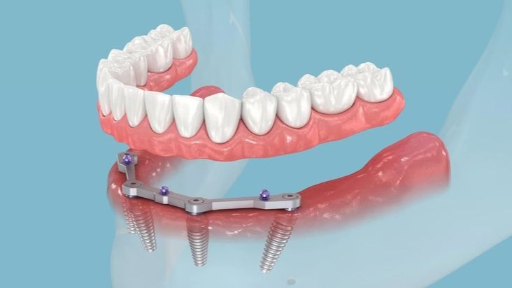teeth replacement without denture,  teeth replacement without denture Pune,  missing teeth replacement Pune,  dental implants Pune,  permanent teeth replacement,  implant dentist Pune,  tooth replacement without dentures,  smile restoration Pune,  DR Hileri Mori Pune,  dental implant clinic Pune