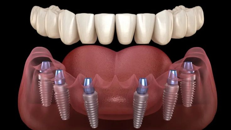 Full Mouth Dental Implants,  Full Mouth Dental Implants Pune,  Best Full Mouth Dental Implants Pune,  DR Hileri Mori,  Dental Implants Pune,  Full Arch Dental Implants Pune,  Implant Dentist Pune,  Teeth Replacement Pune,  Smile Restoration Pune,  Permanent Dental Implants Pune