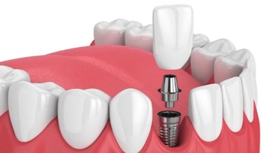 Fixed Teeth Solution in Pune,  Fixed Teeth Solution Pune,  Best Fixed Teeth Solution Pune,  Fixed Teeth Treatment Pune,  Fixed Teeth Replacement Pune,  Fixed Teeth Clinic Pune,  Tooth Replacement Pune,  Fixed Dental Teeth Pune,  Missing Teeth Solution Pune,  DR Hileri Mori Pune