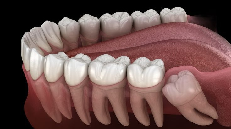 permanent teeth replacement,  permanent teeth replacement Pune,  permanent teeth replacement in Pune,  teeth replacement Pune,  permanent tooth replacement Pune,  missing teeth replacement Pune,  best permanent teeth replacement Pune,  permanent teeth replacement clinic Pune,  permanent teeth replacement dentist Pune,  Dr Hileri Mori Pune