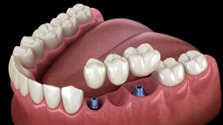 implants for missing teeth,  dental implants,  missing teeth replacement,  dental implant treatment,  tooth replacement options,  dental implants for missing teeth,  single tooth implant,  multiple dental implants,  dental implant procedure,  tooth replacement treatment