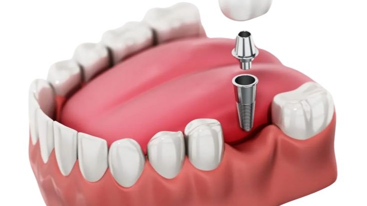 best implantologist in Pune,  Dr. Hileri Mori,  dental implants in Pune,  implantologist in Pune,  dental implant specialist Pune,  best dental implant doctor Pune,  dental implant treatment Pune,  tooth replacement Pune,  dental implants specialist,  implant dentistry Pune