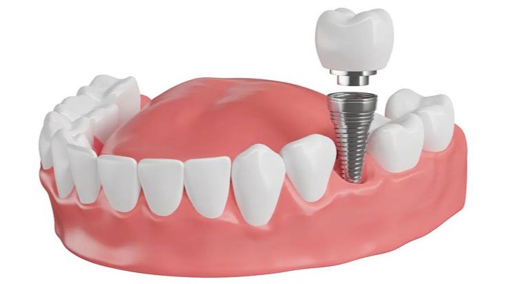 front teeth correction treatment Pune,  aesthetic front teeth correction Pune,  front tooth cosmetic treatment Pune,  crooked front teeth correction Pune,  uneven front teeth treatment Pune,  front teeth smile correction Pune,  advanced teeth correction Pune,  front teeth alignment treatment Pune,  smile enhancement dentist Pune,  Dr Hileri Mori front teeth treatment