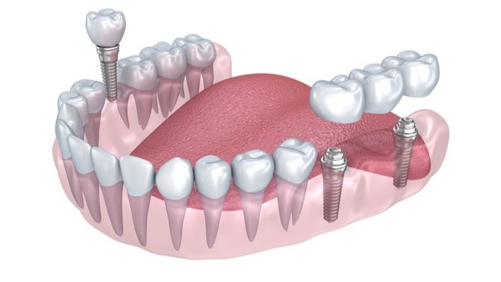 painless dental implant treatment,  painless dental implants,  dental implant treatment Pune,  dental implants in Pune,  Dr. Hileri Mori,  dental implantologist Pune,  dental implants Punawale,  missing teeth replacement Pune,  painless tooth replacement,  dental implant treatment PCMC