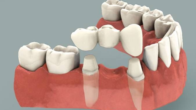 Full Mouth Rehabilitation,  Dr Hileri Mori,  Full Mouth Reconstruction,  Prosthodontist Pune,  Dental Implants Punawale,  Smile Design Specialist,  Worn Teeth Treatment,  Harmony Dental Clinic,  Tooth Replacement Pune,  Complete Dental Restoration