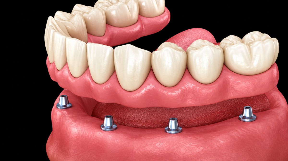 Teeth Replacement Without Dentures,  Teeth Replacement Without Dentures in Pune,  denture free teeth replacement,  fixed teeth replacement Pune,  missing teeth treatment Pune,  dental implants Pune,  permanent teeth replacement Pune,  teeth replacement dentist Pune,  fixed teeth treatment Pune,  Dr. Hileri Mori