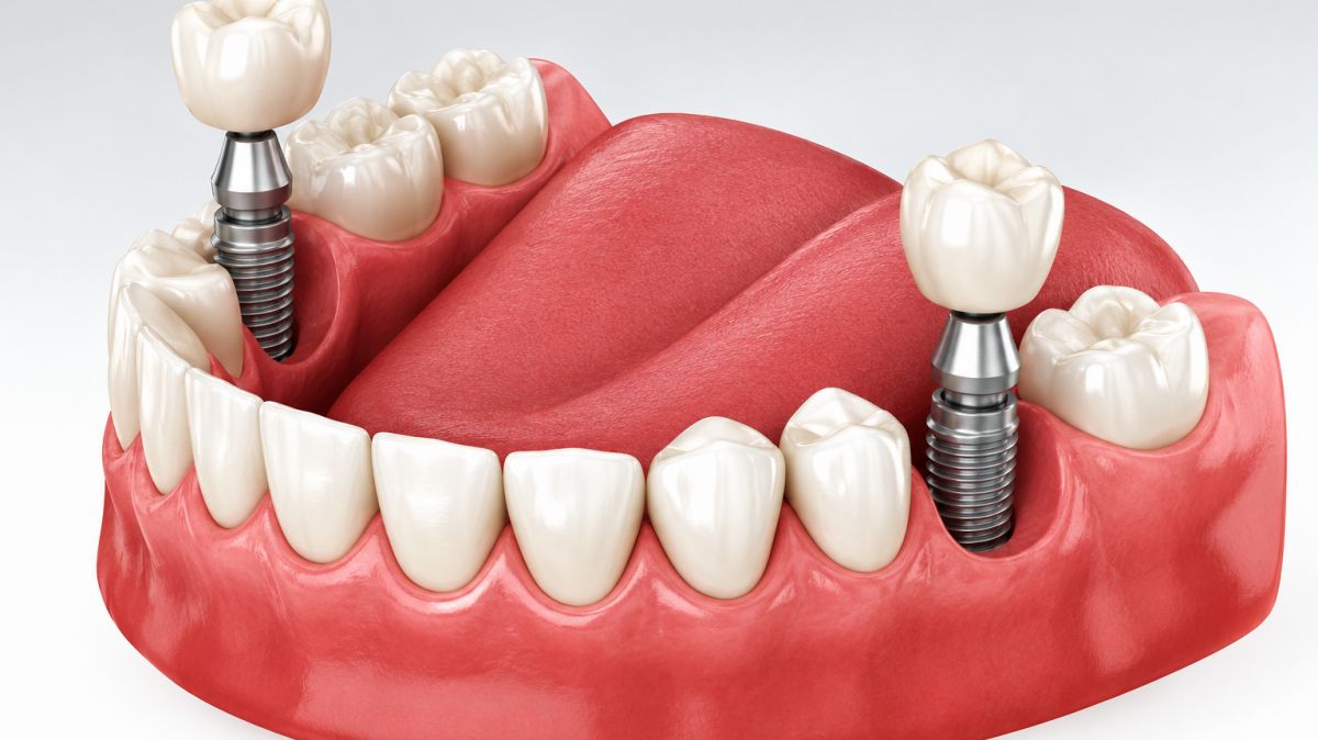 Single tooth dental implant Pune,  single tooth implant Pune,  dental implant in Pune,  tooth replacement Pune,  dental implants India,  single tooth replacement India,  implant dentist Pune,  best dental implant Pune,  tooth implant treatment Pune,  Dr Hileri Mori dental implants