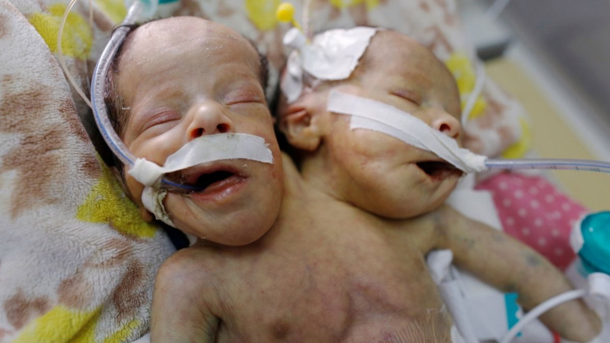 Yemen, World Health Organization, Plea, Twins, Doctors