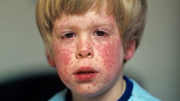 Rubella German Measles: Special Cluster Of Infections.