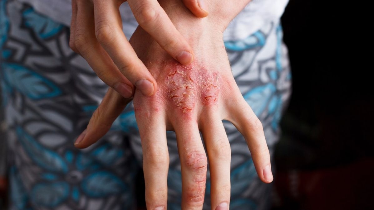 Eczema Rash Become Raw And Tearful On Scratching