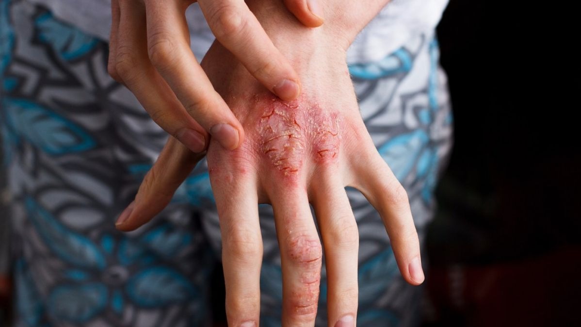 Eczema Rash Become Raw And Tearful On Scratching Eczema Rash Become Raw And Tearful On Scratching