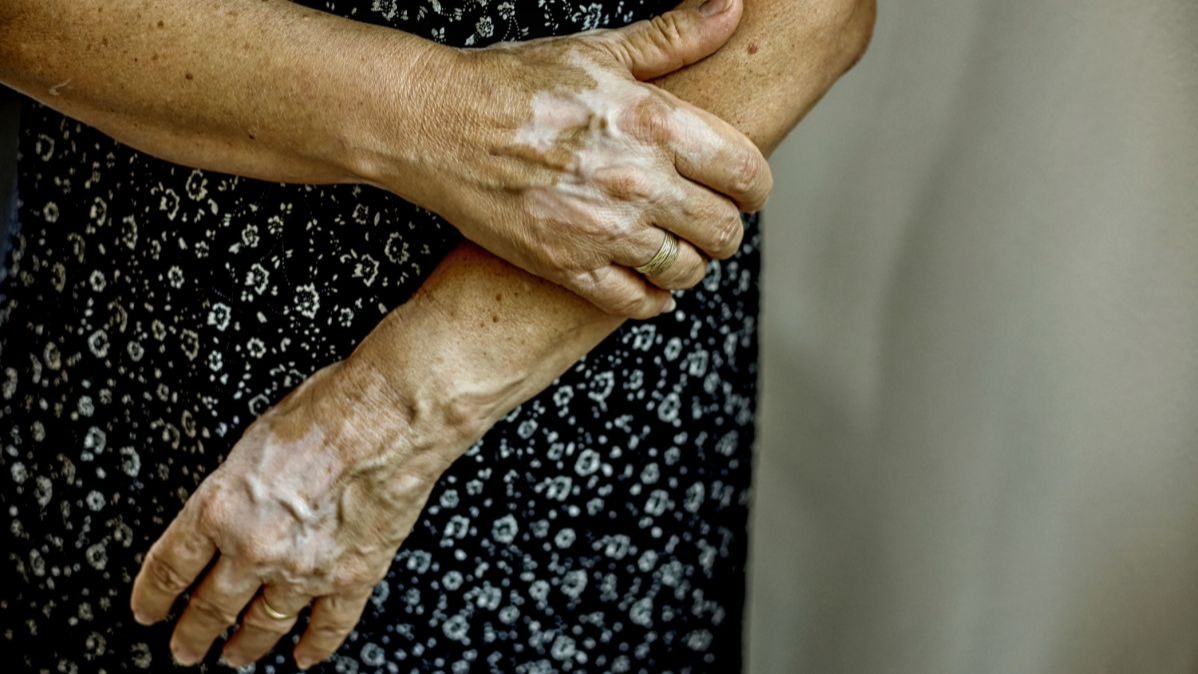 Misdiagnosis, skin disease, Hyderabad,  medicine, metabolic syndromes