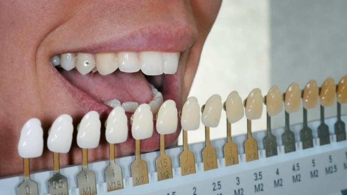 Ceramic Ware Veneers, Hollywood Smile, medical practitioner,  Porcelain Veneer, Veneers