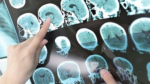 cancer, medication, tumor , glioblastoma , brain cancer