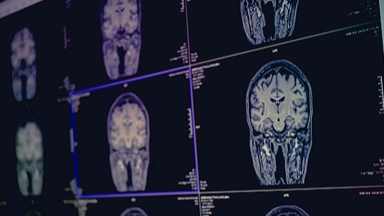 seemingly, vascular dementia, strokes, Researchers, cambridge