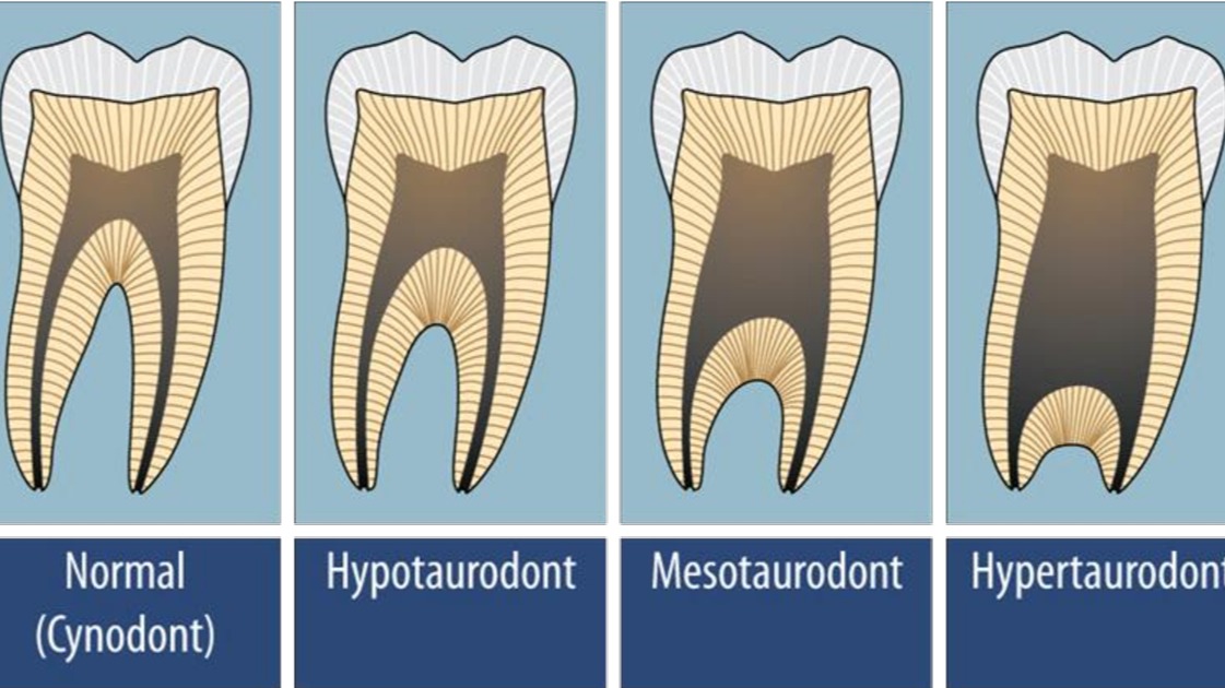 Taurodontism, bull tooth, clinical features of taurodontism , diagnosis of taurodontism, treatement of taurodontism, radiographic features of taurodontism, causes of taurodontism, clinical findings of taurodontism, hypotaurodont, mesotaurodont