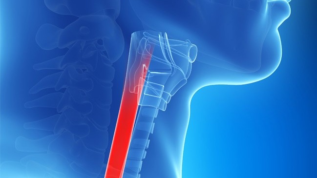 dysphagia, pathophysiology of dysphagia, treatment of dysphagia, difficulty in swallowing, fluoroscopy, pharyngeal/oral dysphagia, oesophageal dysphagia, What is Dysphagia
